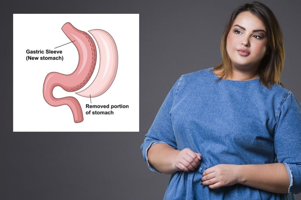 how much stomach is removed gastric sleeve