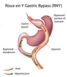 roux-en-y bypass