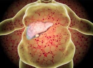 fatty liver