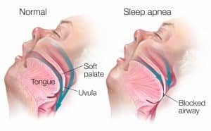 diagram of snoring