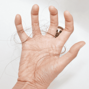 Hair Loss after Bariatric Surgery
