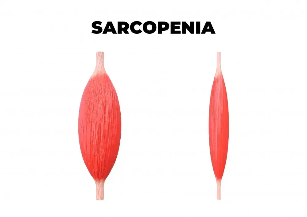 Sarcopenia