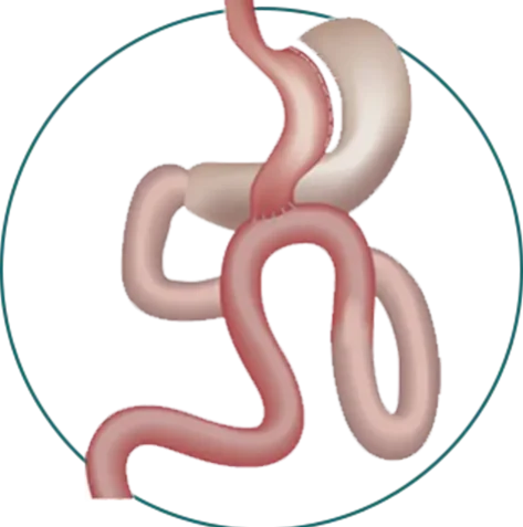 Mini-Gastric-Bypass